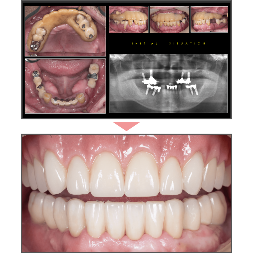 全顎治療（重度歯周病）